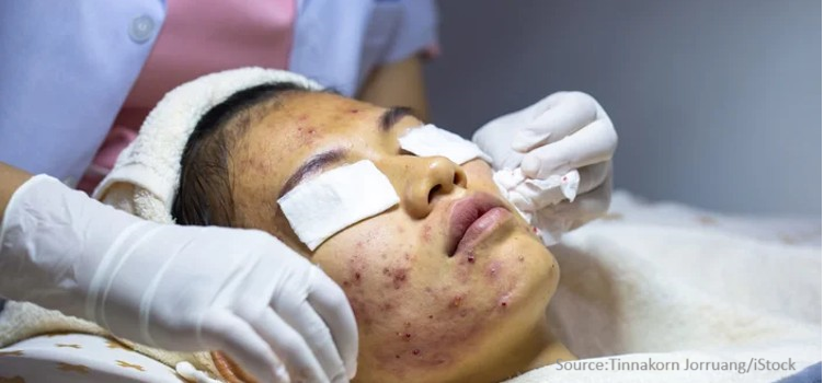 From Breakouts to Breakthroughs: The Future of Acne Treatment 